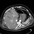 Acute pancreatic necrosis (Radiopaedia 13560-13486 Axial C+ portal venous phase 33).jpg
