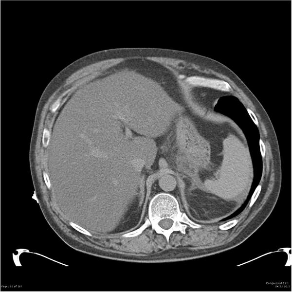 File:Acute pancreatitis (Radiopaedia 19135-19116 Axial non-contrast 6).jpg