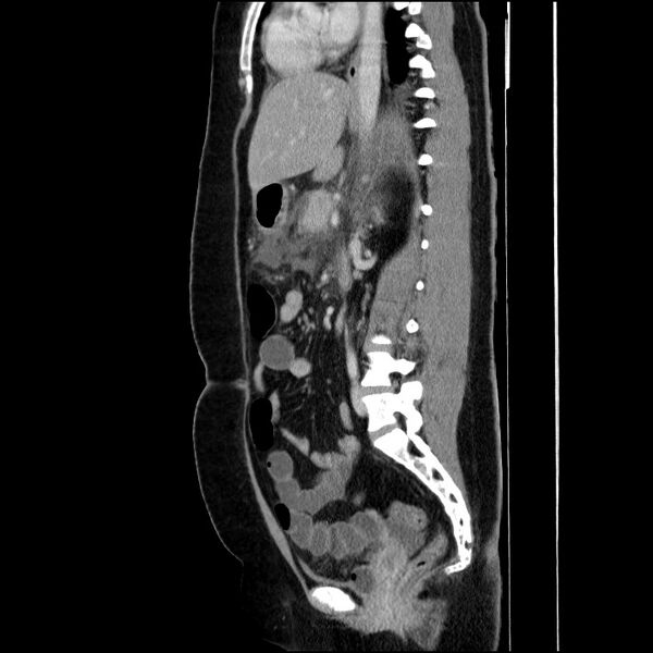 File:Acute pancreatitis (Radiopaedia 69236-79012 Sagittal C+ portal venous phase 49).jpg