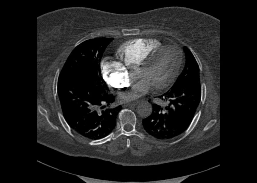 Acute pulmonary embolism (Radiopaedia 29938-30466 Axial C+ CTPA 122).jpg