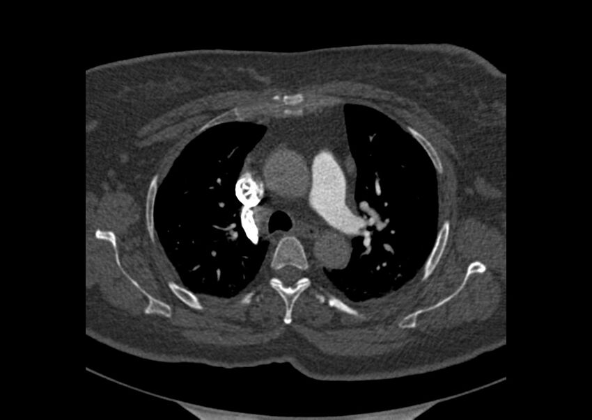 Acute pulmonary embolism (Radiopaedia 29938-30466 Axial C+ CTPA 20).jpg