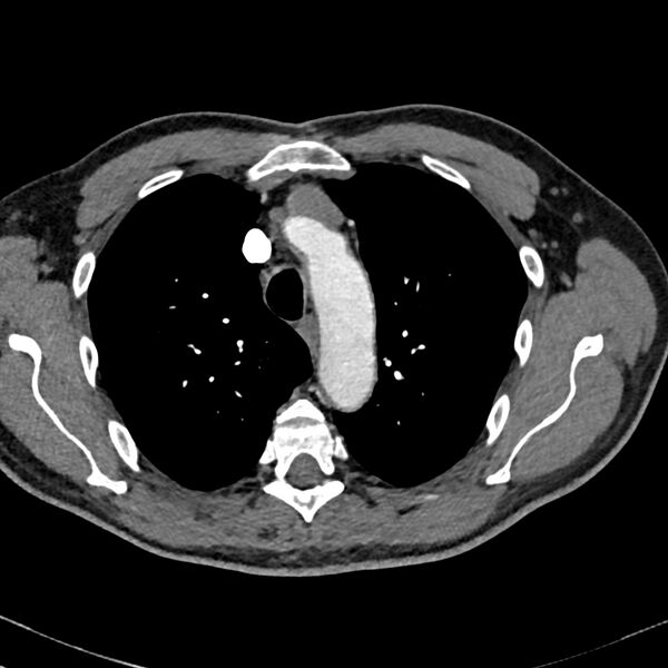 File:Acute pulmonary embolism (Radiopaedia 81677-95570 Axial C+ CTPA 7).jpg