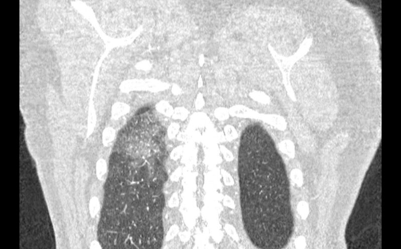 File:Acute pulmonary embolism with pulmonary infarcts (Radiopaedia 77688-89908 Coronal lung window 96).jpg