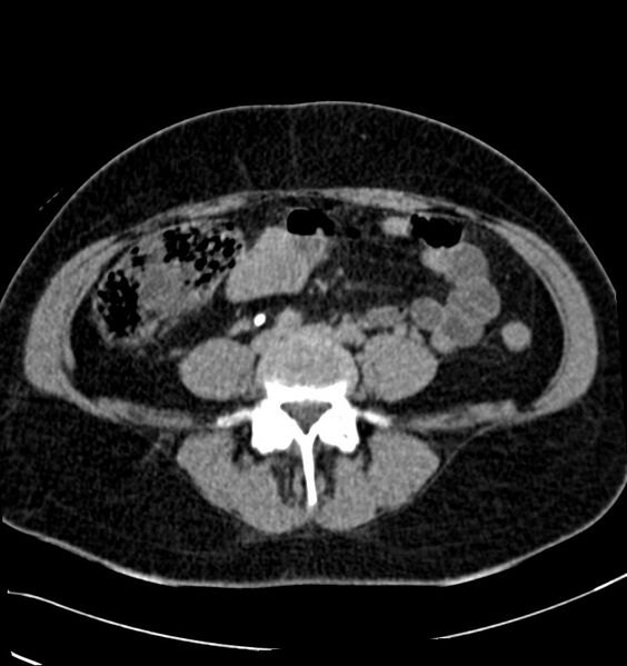 File:Acute pyelonephritis (Radiopaedia 40264-42816 Axial renal excretory phase 22).jpg