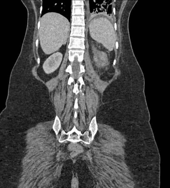File:Acute pyelonephritis with renal vein thrombosis (Radiopaedia 58020-65053 Coronal renal parenchymal phase 105).jpg