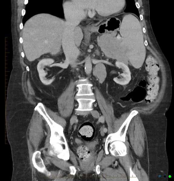 File:Acute renal failure post IV contrast injection- CT findings (Radiopaedia 47815-52559 Coronal C+ portal venous phase 17).jpg
