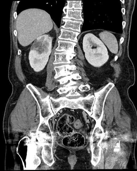 File:Acute renal infarction - rim capsular enhancement (Radiopaedia 59833-67270 Coronal C+ portal venous phase 45).jpg