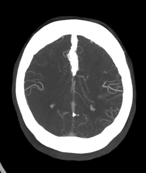 File:Acute right MCA M1 occlusion (Radiopaedia 62268-70454 Axial Phase 1 10).jpg