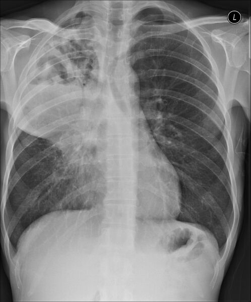 File:Acute right lung abscess (Radiopaedia 34806-36257 Frontal 1).jpg