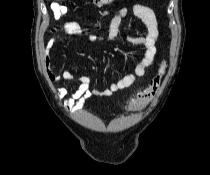 File:Acute sigmoid colon diverticulitis (Radiopaedia 55507-61976 Coronal C+ portal venous phase 15).jpg