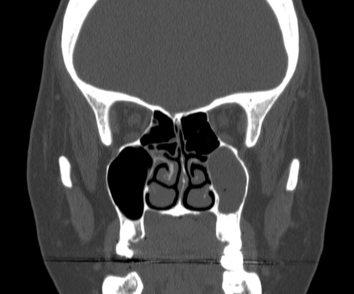 File:Acute sinusitis (Radiopaedia 22419-22455 Coronal bone window 21).jpg