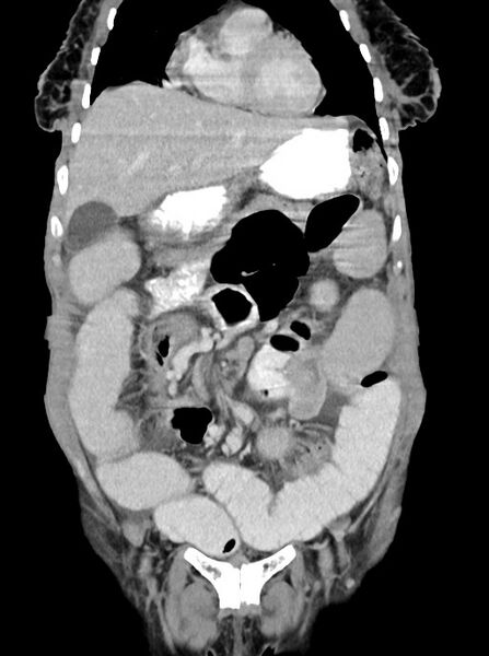 File:Acute small bowel (ileal) volvulus (Radiopaedia 71740-82139 Coronal C+ portal venous phase 37).jpg