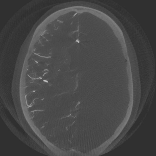 File:Acute subarachnoid hemorrhage and accessory anterior cerebral artery (Radiopaedia 69231-79010 Axial arterial - MIP 46).jpg