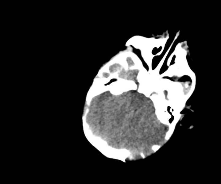 File:Acute ventriculitis (Radiopaedia 57502-64459 Axial non-contrast 5).jpg