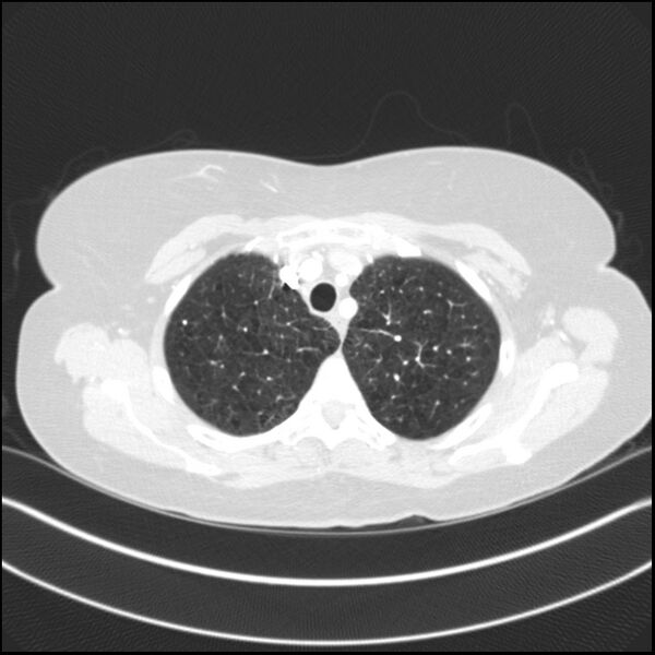 File:Adenocarcinoma of the lung (Radiopaedia 44205-47803 Axial lung window 22).jpg