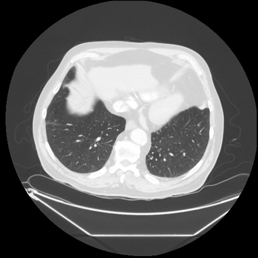 Adenocarcinoma of the lung (Radiopaedia 44876-48759 Axial lung window 62).jpg