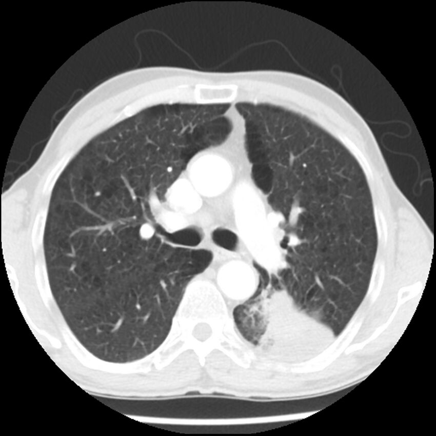 Adenocarcinoma of the lung - micropapillary predominant (Radiopaedia 42446-45563 Axial lung window 30).jpg
