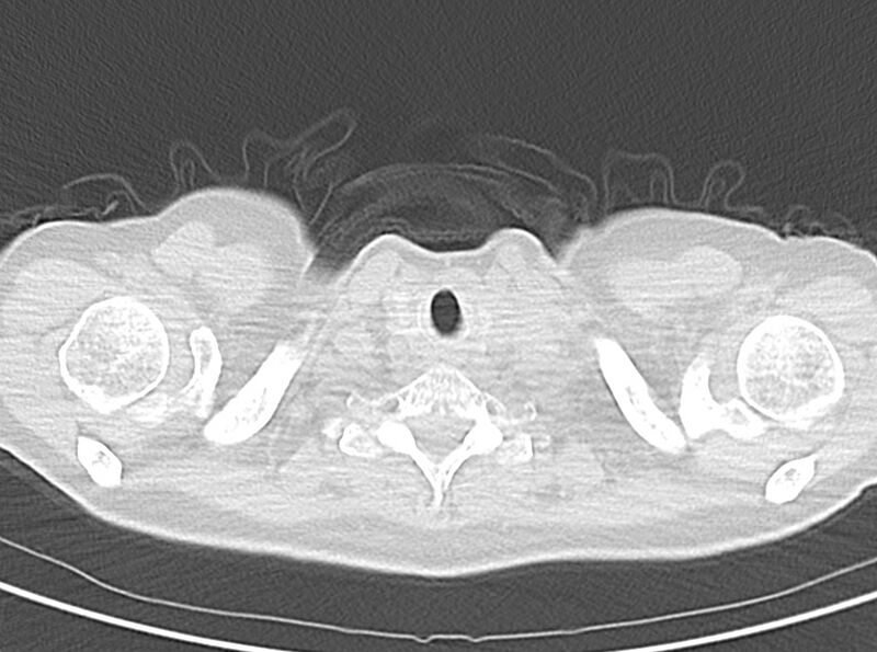 File:Adenosquamous lung carcinoma (Radiopaedia 22035-22030 lung window 9).jpg