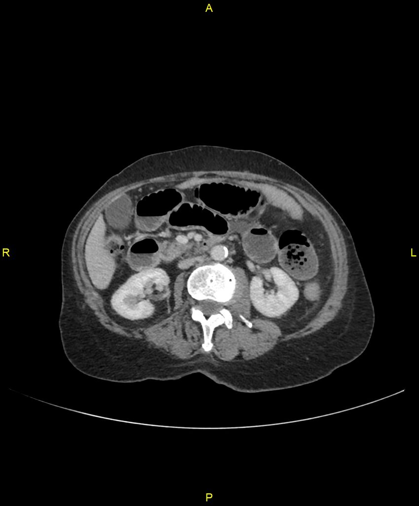 Adhesional small bowel obstruction (Radiopaedia 85402-101024 Axial C+ portal venous phase 122).jpg