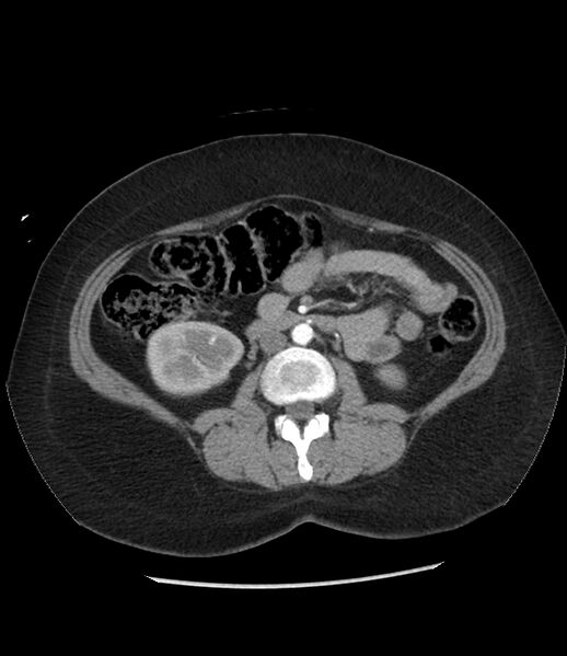 File:Adrenal cortical carcinoma with IVC invasion and thrombosis (Radiopaedia 34307-35597 Axial C+ arterial phase 45).jpg