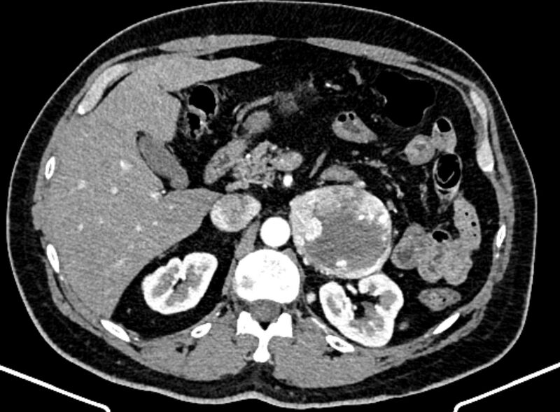 File:Adrenal metastases (Radiopaedia 73082-83791 Axial C+ arterial phase 57).jpg