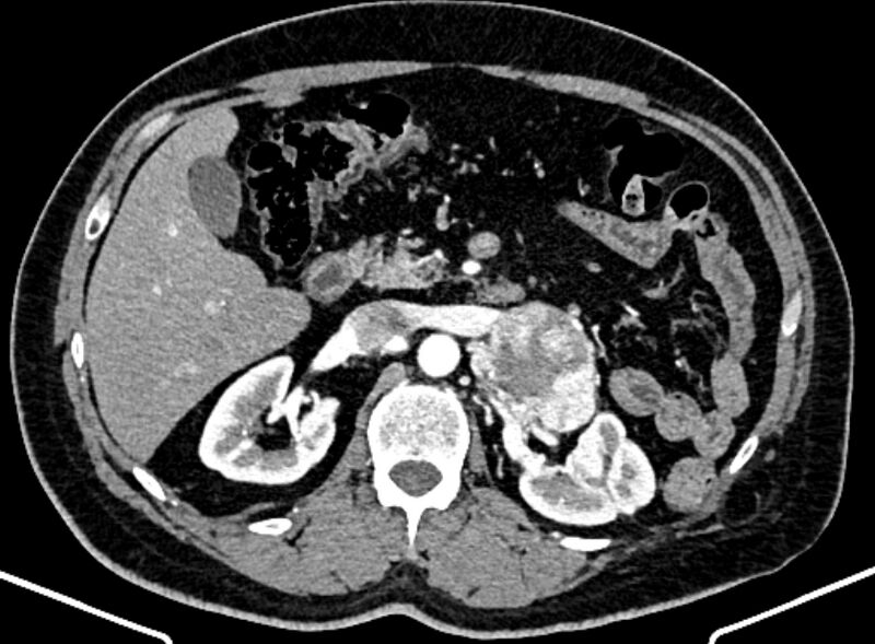 File:Adrenal metastases (Radiopaedia 73082-83791 Axial C+ arterial phase 66).jpg