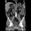 Adrenal myelolipoma (Radiopaedia 41843-44834 Coronal non-contrast 5).jpg