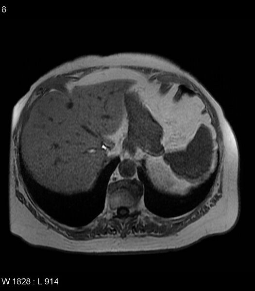 File:Adrenal myelolipoma (Radiopaedia 6765-7961 Axial T1 in-phase 8).jpg