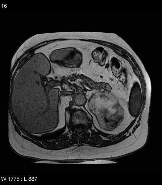 File:Adrenal myelolipoma (Radiopaedia 6765-7961 Axial T1 out-of-phase 16).jpg