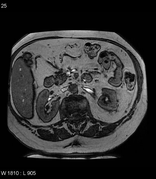 File:Adrenal myelolipoma (Radiopaedia 6765-7961 Axial T1 out-of-phase 25).jpg