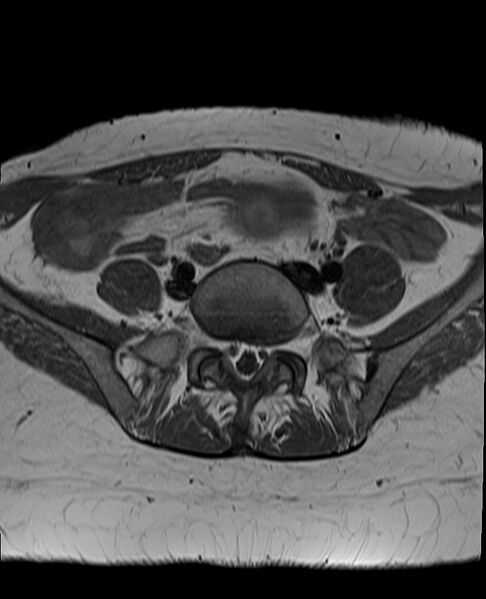 File:Adult granulosa cell tumor of the ovary (Radiopaedia 71581-81950 Axial T1 5).jpg