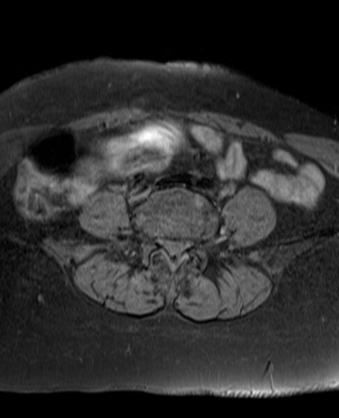 File:Adult granulosa cell tumor of the ovary (Radiopaedia 71581-81950 Axial T1 fat sat 2).jpg