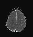Aicardi syndrome (Radiopaedia 66029-75205 Axial ADC 17).jpg