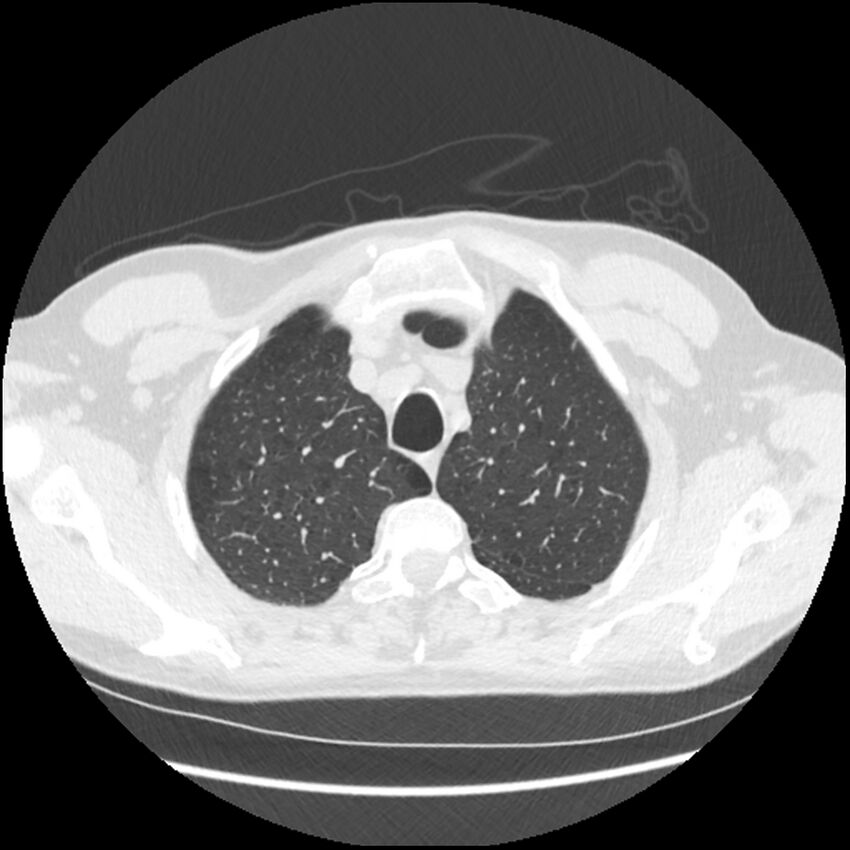 Alpha-1-antitrypsin deficiency (Radiopaedia 40993-43722 Axial lung window 33).jpg