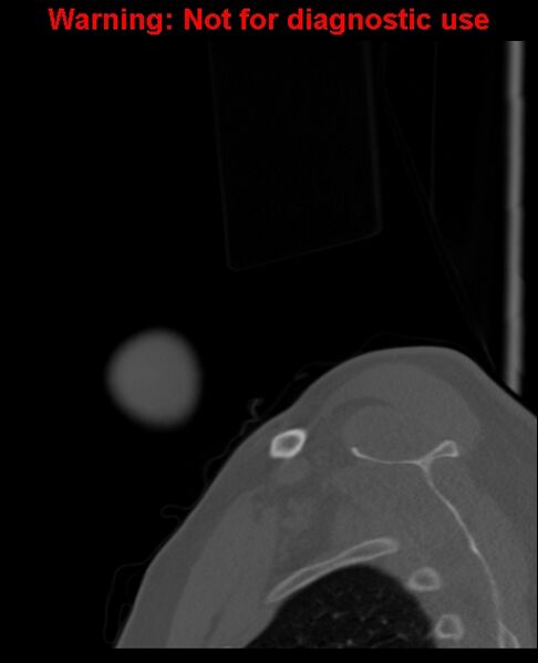 File:Ameloblastoma (Radiopaedia 33126-34164 Sagittal bone window 6).jpg