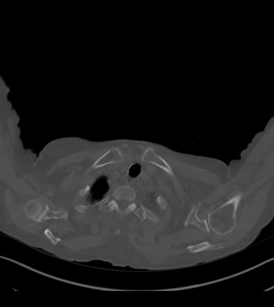 File:Amiodarone deposition in the liver (Radiopaedia 77587-89780 Axial bone window 7).jpg