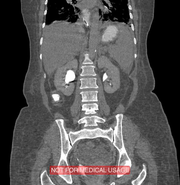 File:Amoebic enterocolitis with liver abscess (Radiopaedia 35100-36609 B 132).jpg