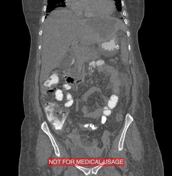 File:Amoebic enterocolitis with liver abscess (Radiopaedia 35100-36609 B 78).jpg