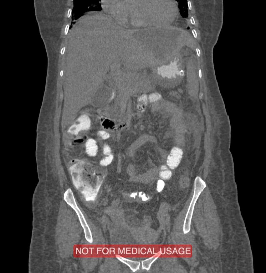 Amoebic enterocolitis with liver abscess (Radiopaedia 35100-36609 B 78).jpg