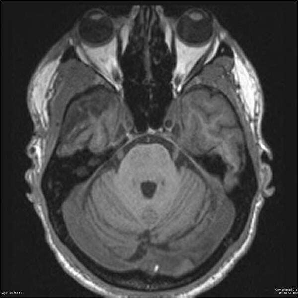 File:Anaplastic meningioma with recurrence (Radiopaedia 34452-35788 Axial T1 36).jpg