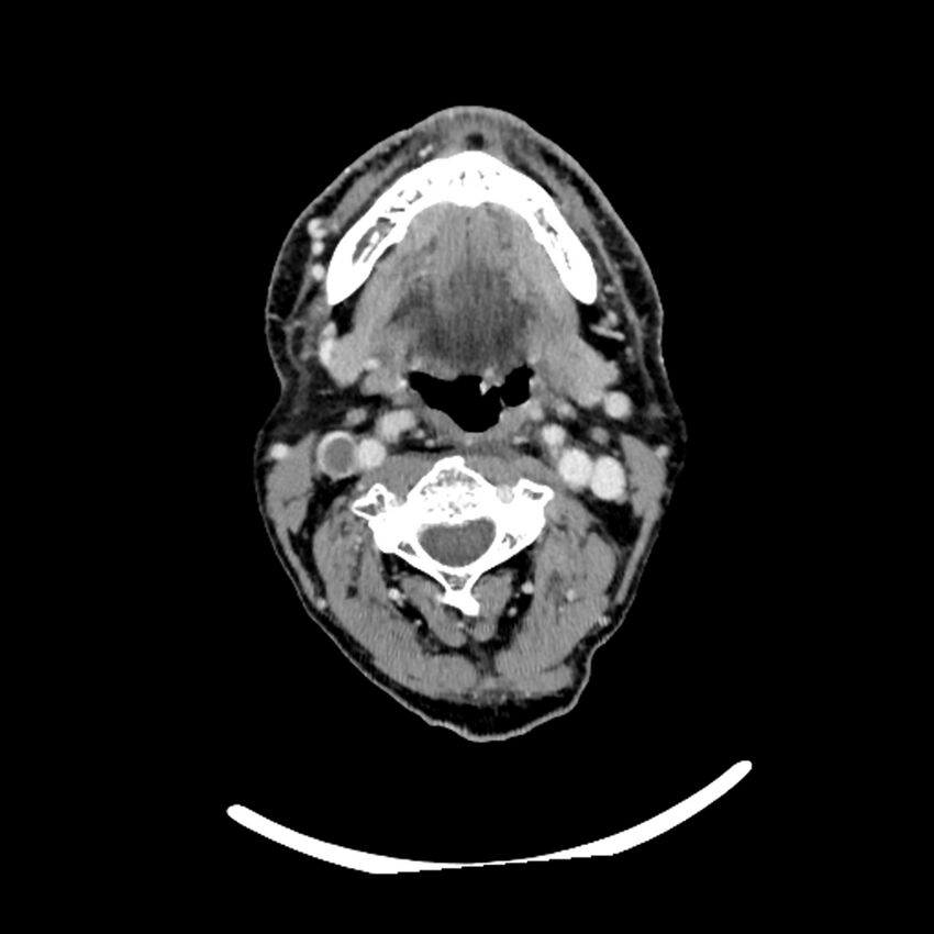 Anaplastic thyroid carcinoma (Radiopaedia 79087-92034 B 82).jpg