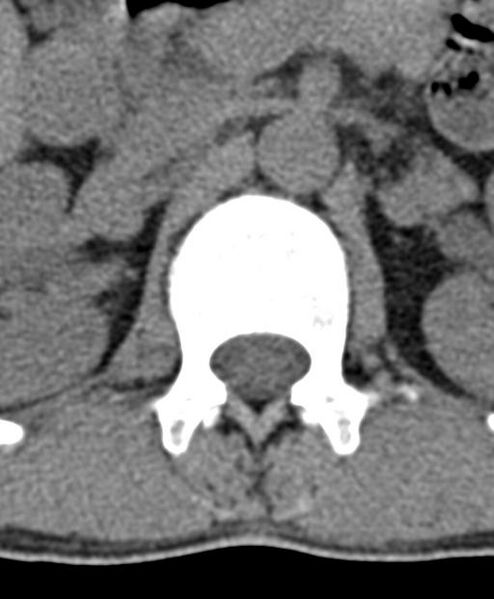 File:Aneurysmal bone cyst T11 (Radiopaedia 29294-29721 Axial non-contrast 62).jpg