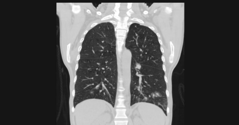 File:Angioinvasive aspergellosis (Radiopaedia 66995-76315 Coronal lung window 42).jpg