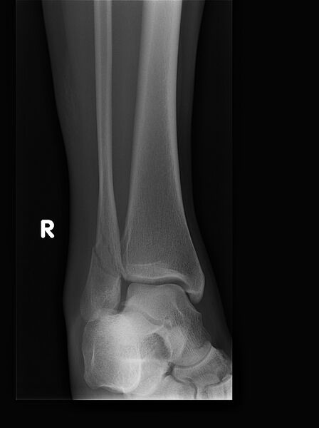 File:Ankle fracture - Weber B (Radiopaedia 46843-51371 B 1).jpg