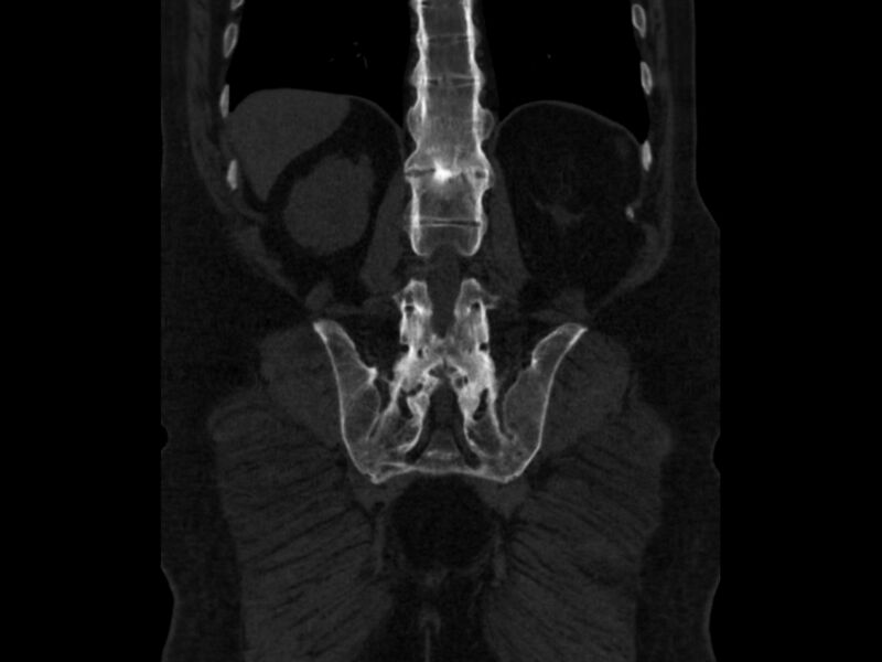 File:Ankylosing spondylitis (Radiopaedia 44609-48357 Coronal bone window 74).jpg