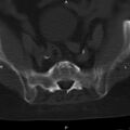 Ankylosing spondylitis (Radiopaedia 8748-9556 Axial bone window 49).jpg