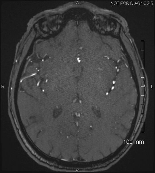 File:Anterior cerebral artery aneurysm (Radiopaedia 80683-94127 Axial MRA 130).jpg