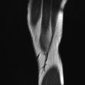 Anterior cruciate ligament full thickness tear (Radiopaedia 66268-75467 Sagittal T2 2).jpg