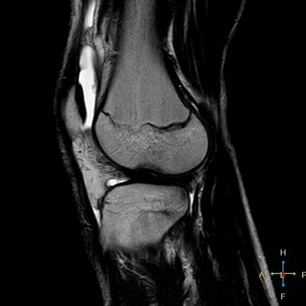File:Anterior cruciate ligament tear - complete (Radiopaedia 24907-25170 Sagittal T2 4).jpg