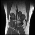 Anterior cruciate ligament tear with posteromedial corner injury, bucket-handle meniscal tear and chondral delamination (Radiopaedia 75501-86744 Coronal T1 22).jpg